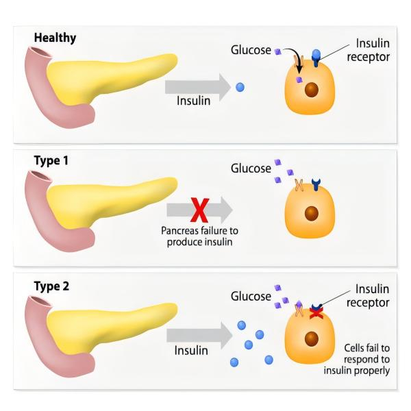 Programa de Rehabilitación Nutricional para la Diabetes